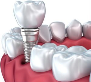 Dental Implants Mithran Dental clinic Adyar