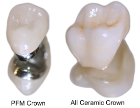 types-of-crown-materials